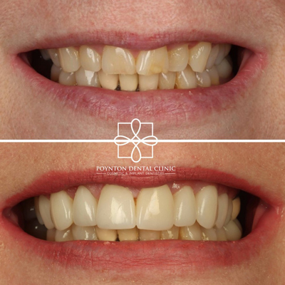 before and after dental treatment showing improved smile aesthetics with bright white teeth from Poynton Dental Clinic 3 dental procedures