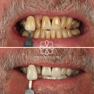comparison of dental shades for a smile makeover before and after using 14 different shades for accurate matching